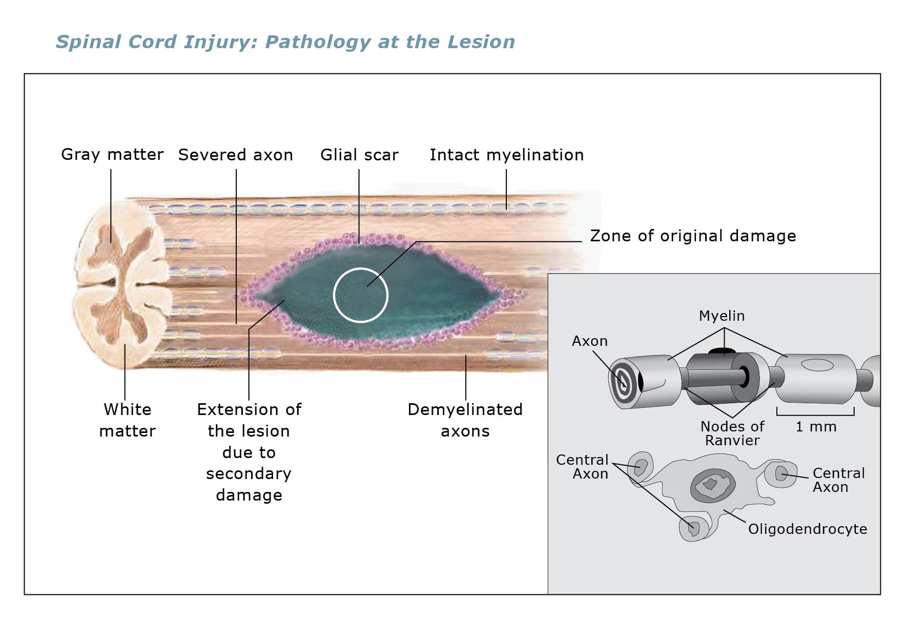 Spinal Cord Injury: Pathology at the Lesion