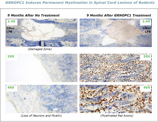 GRNOPC1 Induces Permanent Myelination in Spinal Cord Lesions in Rodents